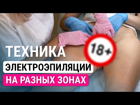 Видео: Урок №44. Электроэпиляция на разных зонах - техника электроэпиляции без боли