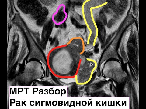 Видео: Подробный разбор МРТ рака сигмовидной кишки