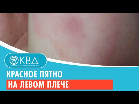 Видео: 😕 Красное пятно на левом плече. Клинический случай №816