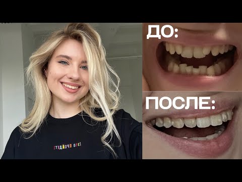 Видео: ЧТО С МОИМИ ЗУБАМИ? // ИСТОРИЯ МОЕЙ УЛЫБКИ