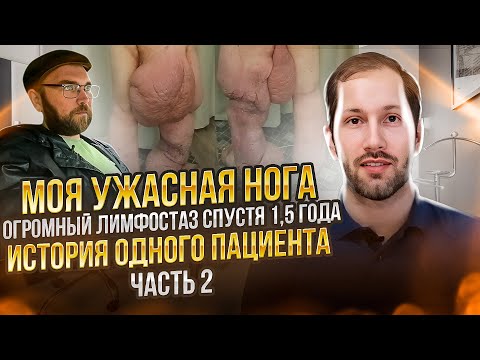Видео: МОЯ УЖАСНАЯ НОГА: огромный лимфостаз (слоновость) -  часть 2  через 1,5 года
