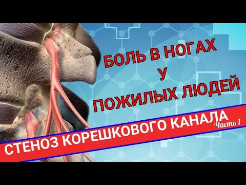 Видео: НАРАСТАЮЩАЯ БОЛЬ В НОГАХ. Стеноз корешкового канала (Часть 1)
