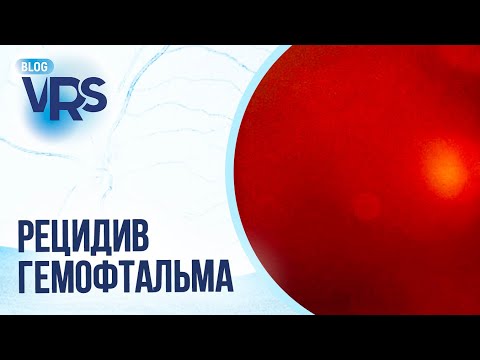 Видео: Сахарный диабет / Диабетическая ретинопатия / Рецидив гемофтальма