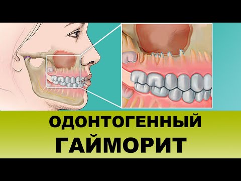 Видео: ОДОНТОГЕННЫЙ ГАЙМОРИТ