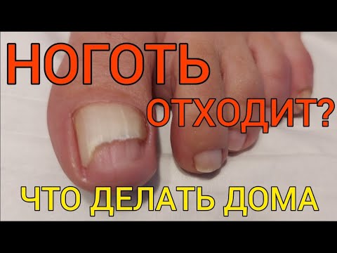 Видео: Ноготь отходит от пальца? Лучшие домашние ванночки при онихолизисе