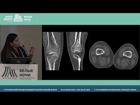 Видео: Гигантоклеточные опухоли костей (Чуглова Д.А.)