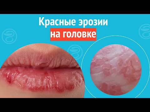 Видео: 😦 Красные эрозии на головке. Клинический случай №1653