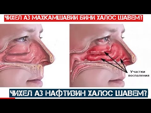 Видео: Чихел аз махкамшавии бини халос шавем?