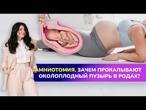 Видео: Как прокалывают околоплодный пузырь в родах💦? ЧТО ТАКОЕ АМНИОТОМИЯ