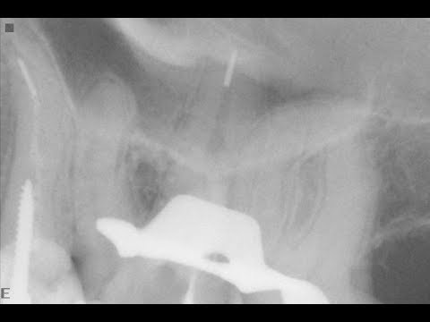 Видео: DentalПлюшки 35 - файлы SOCO SC Pro