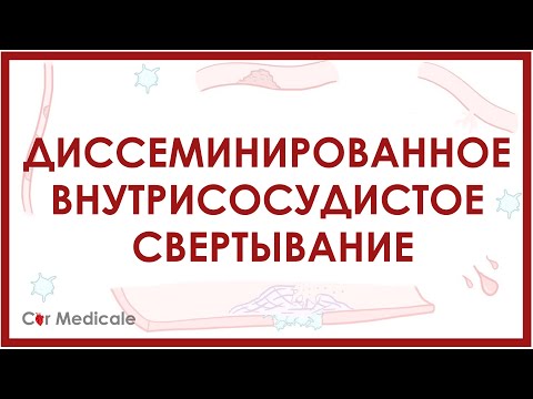 Видео: Диссеминированное внутрисосудистое свертывание - что такое, механизм развития, в чем опасность