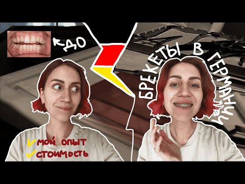 Видео: 7; БРЕКЕТЫ В ГЕРМАНИИ: ПЕРЕЕЗД С БРЕКЕТАМИ; ДО/ПОСЛЕ; СКОЛЬКО СТОИТ; МОЯ ИСТОРИЯ | ДНЕВНИК ПОЕХАВШЕЙ