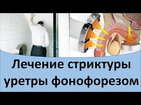 Видео: Лечение стриктуры уретры фонофорезом