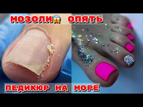 Видео: Педикюр в отпуск 🦶Как удалить подногтевые мозоли 🦶Дизайн ногтей на ногах