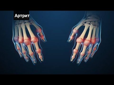 Видео: Ревматоидный Артрит - Это Может Помочь