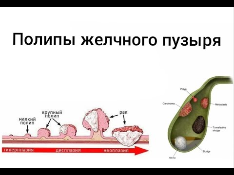 Видео: Полипы желчного пузыря