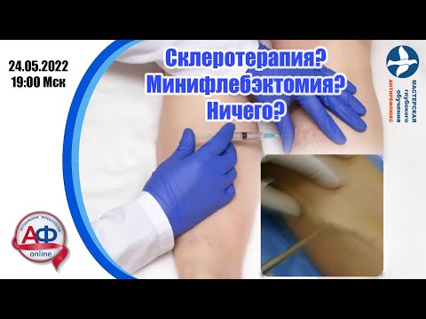 Видео: Склеротерапия? Минифлебэктомия? Ничего?