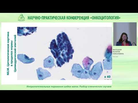 Видео: Интраэпителиальные поражения шейки матки. Разбор клинических случаев