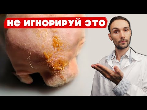 Видео: Здоровая кожа у морской свинки за 5 минут! Очиститка сальной железы у морской свинки