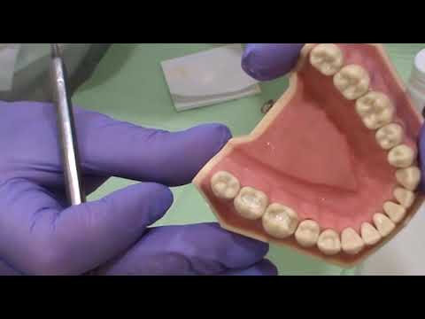 Видео: Пломбирование II класса композитом химического отверждения часть1
