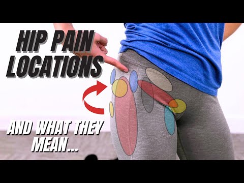 Видео: Вот почему у вас болит бедро: проблемы и типы боли в бедре по местоположению