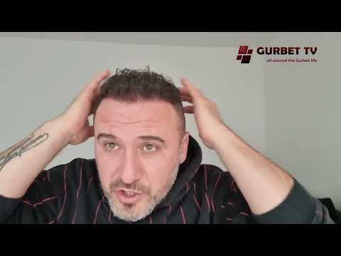 Видео: Присаждане на Коса в Турция. Една година след присаждането на Косата.