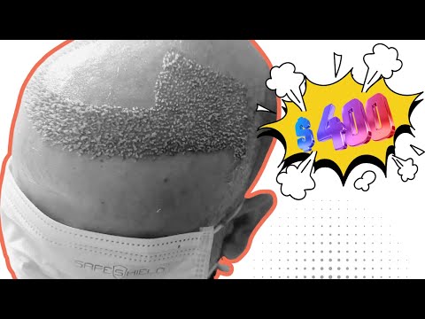 Видео: Какова стоимость пересадки волос в Индии?