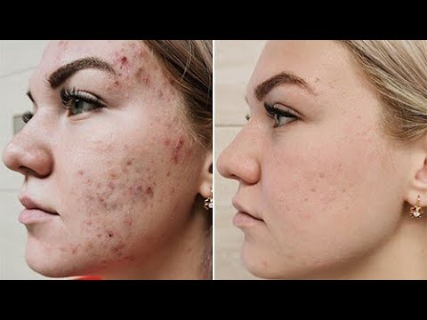 Видео: Терапия акне системными ретиноидами (проф. Аравийская)