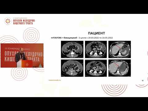 Видео: Разбор клинических наблюдений: рак тонкой кишки