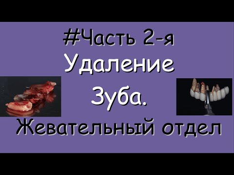 Видео: Удаление зуба. Часть 2. Жевательный отдел.