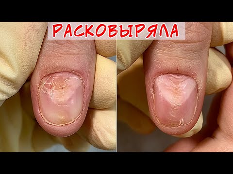 Видео: Расковыряла ногти / Почему ногти волнистые?