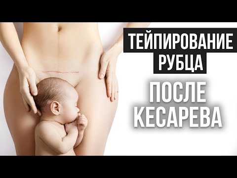 Видео: ТЕЙПИРОВАНИЕ РУБЦА ПОСЛЕ КЕСАРЕВА СЕЧЕНИЯ. Дмитрий Горковский и Марина Осокина