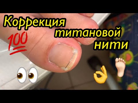 Видео: Коррекция титановой нити 👌💯🦶🏻👀