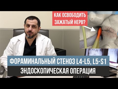 Видео: Лечение фораминального стеноза позвоночного канала L4 L5, L5 S1  Разбор МРТ поясничного отдела