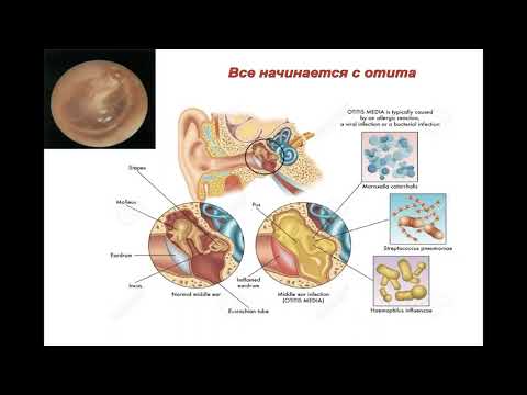 Видео: Опухоли & не опухоли уха и основания черепа. Сложности дифференциальной диагностики (Степанова Е.А.)