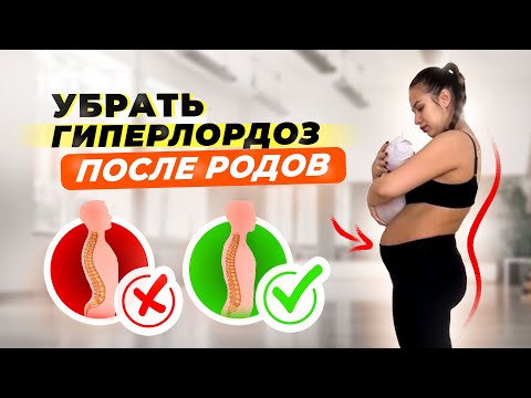 Видео: 4 ГЛАВНЫХ УПРАЖНЕНИЯ ОТ ГИПЕРЛОРДОЗА ПОСЛЕ РОДОВ