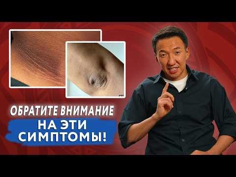 Видео: Эти 7 признаков ДИАБЕТА нужно знать КАЖДОМУ! #докторжимба