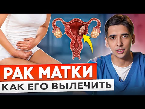 Видео: РАК тела МАТКИ. Прогнозы при раке эндометрия. Удаление матки.