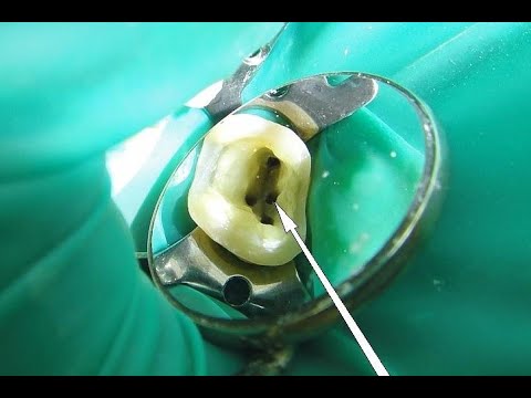 Видео: Лекция 2. ФУВ. Эндодонтия