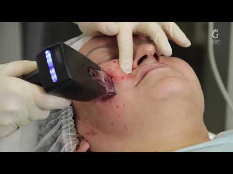 Видео: Аппаратная подтяжка лица. RF-лифтинг Morpheus 8.