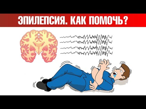 Видео: Эпилепсия (судороги, припадки) 👉 есть решение