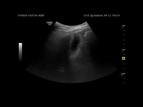 Видео: Ультразвуковая диагностика. Доктор Иогансен. Видеопримеры. Выпуск 79. Хронический холецистит.