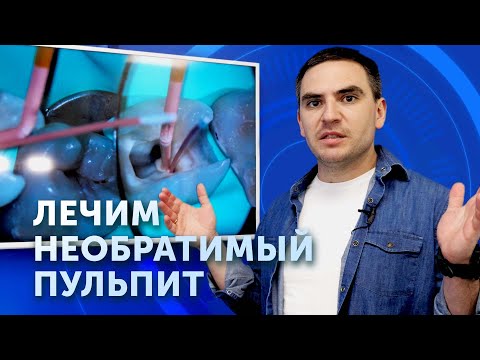 Видео: Как лечится необратимый пульпит