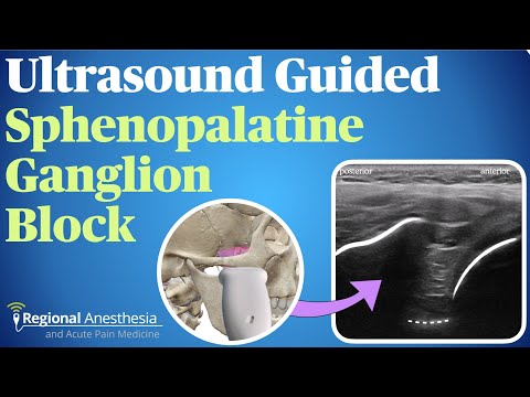 Видео: Блокада клиновидно-небного ганглия под контролем УЗИ
