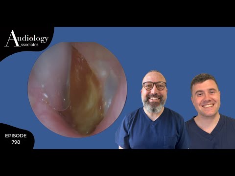 Видео: ЭПИЧЕСКОЕ СРЕДСТВО ОТ УШНОЙ СЕРЫ С БАРАБАННОЙ ПЕРЕПОНКИ - EP 798