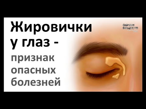Видео: «Жировички» у глаз – признак опасных болезней (ксантелазма)
