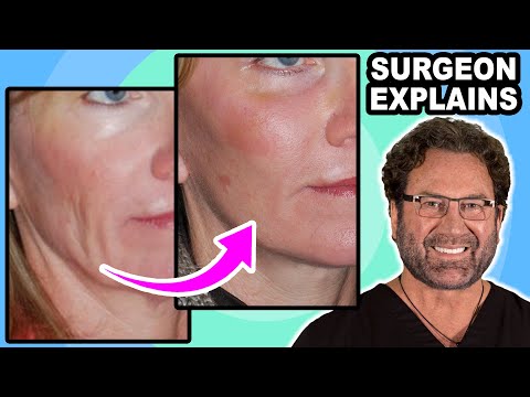 Видео: Что такое эндоскопическая подтяжка лица? Пластический хирург рассказывает