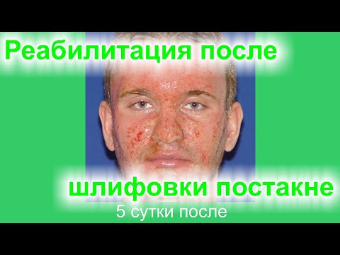 Видео: Реабилитация после лазерной шлифовки рубцов постакне. # 15