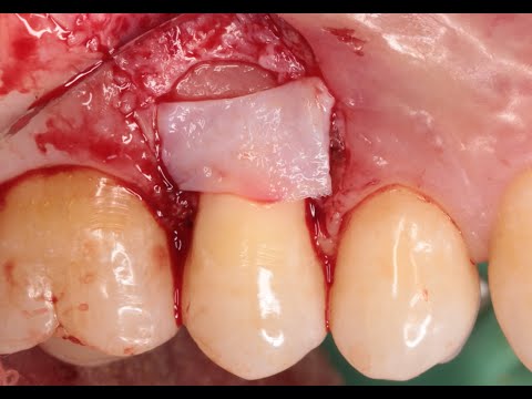 Видео: Не надо ничего придумывать! Двухслойная методика закрытия рецессии.