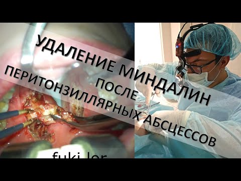 Видео: УДАЛЕНИЕ МИНДАЛИН ПОСЛЕ ПЕРИТОНЗИЛЛЯРНЫХ АБСЦЕССОВ оперирует ЛОР-хирург к.м.н. Фуки Е. М.